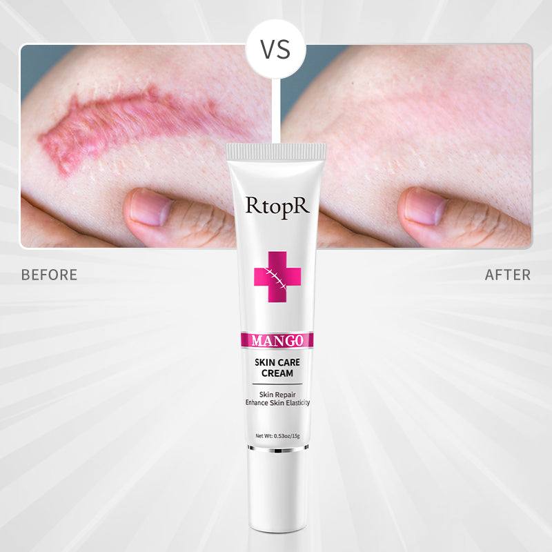 RtopR【Official Store】Mango Skin Repair Cream Fade Scar Stretch Marks Remover Cream Skin Repair Face Cream Acne Spots Treatment  0.53oz/15g